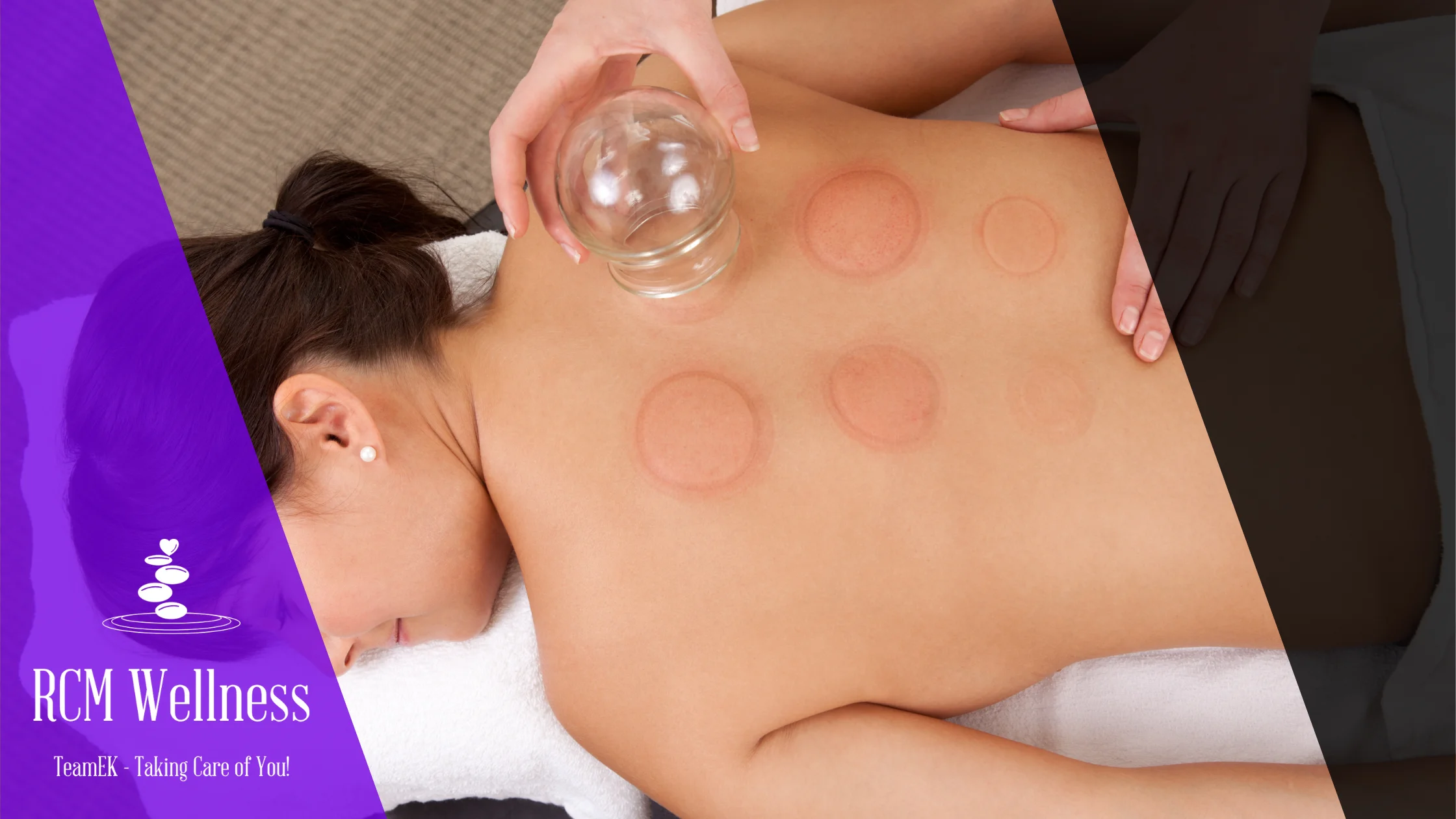 Dry Cupping (Body) At RCM Wellness