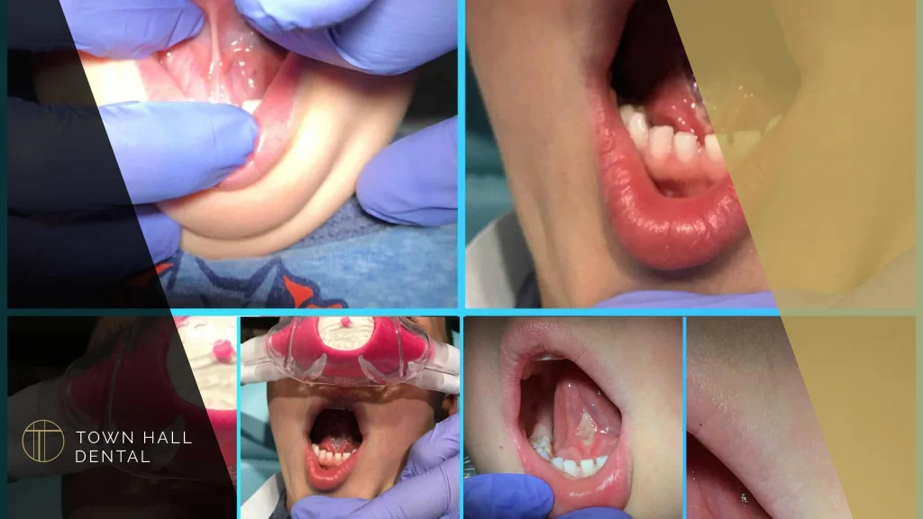 Children Tongue Tie 2