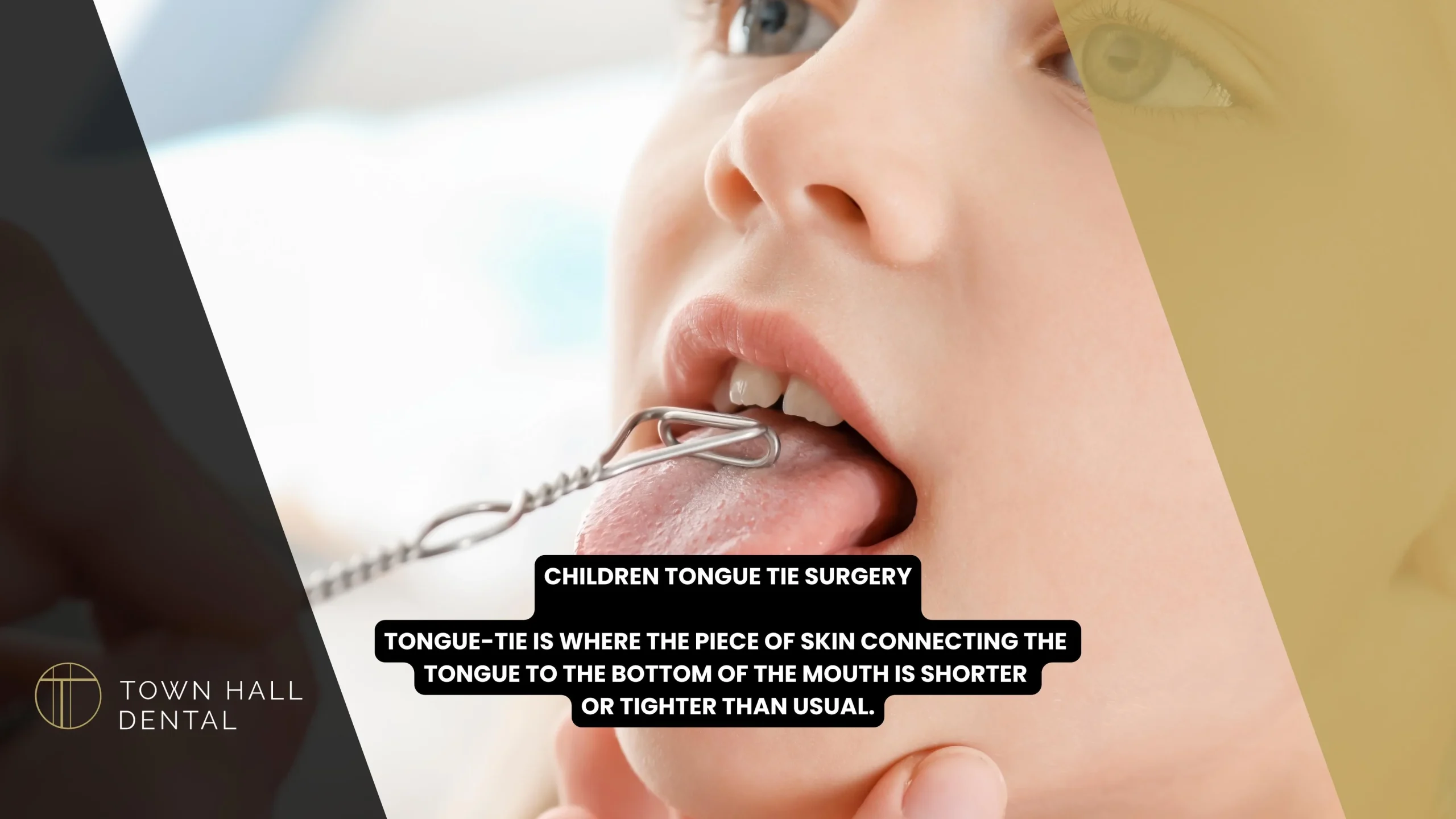 Children’s Tongue Tie Surgery