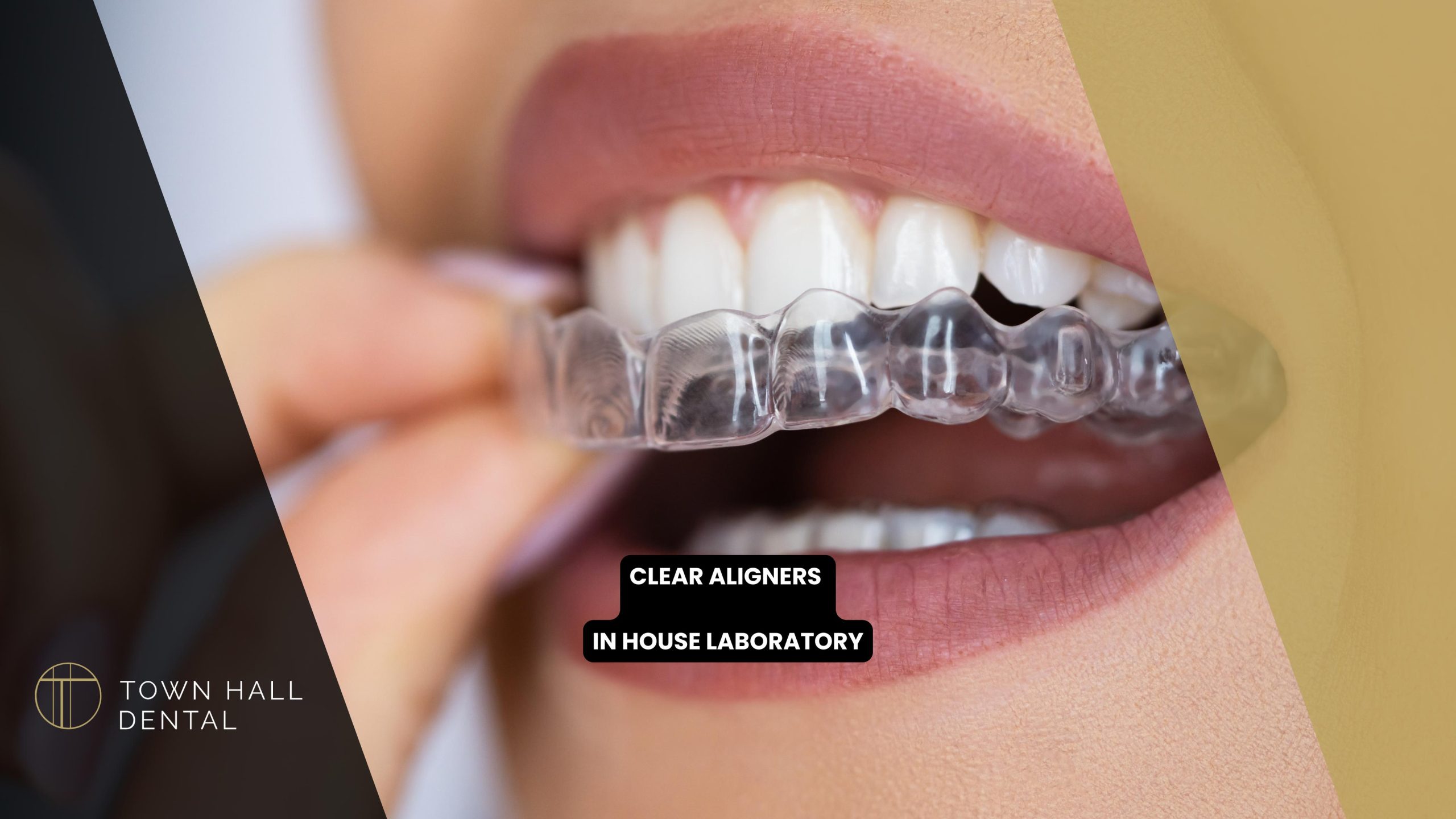 Clear Aligners