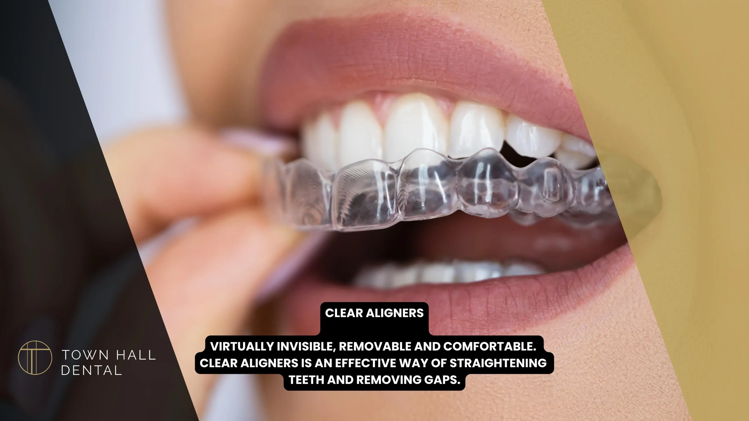 Clear Aligners