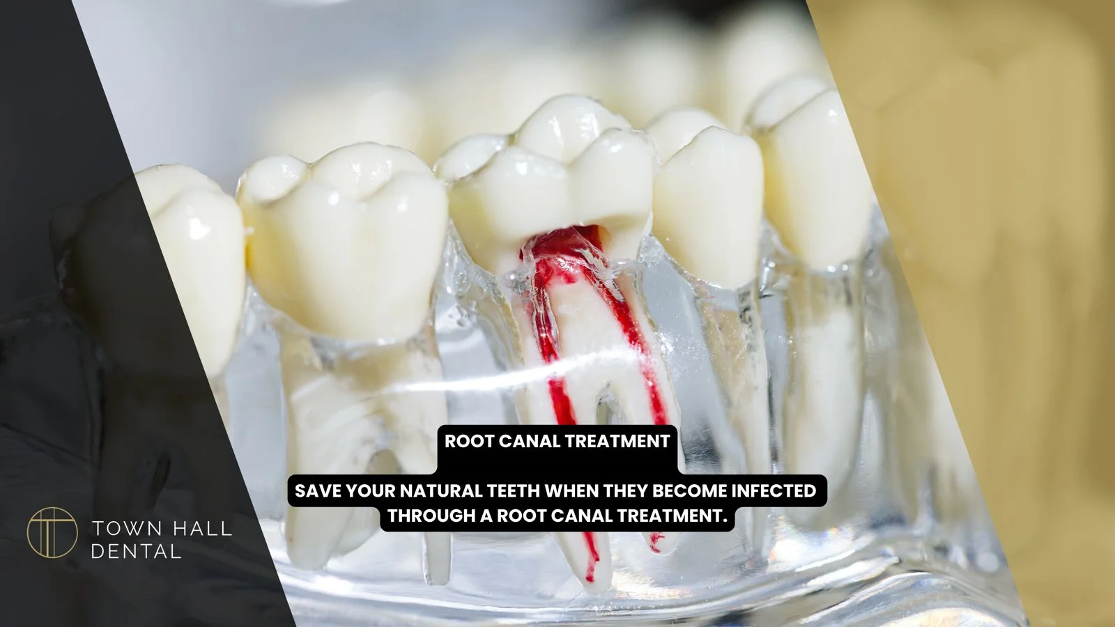 Root Canal Treatment