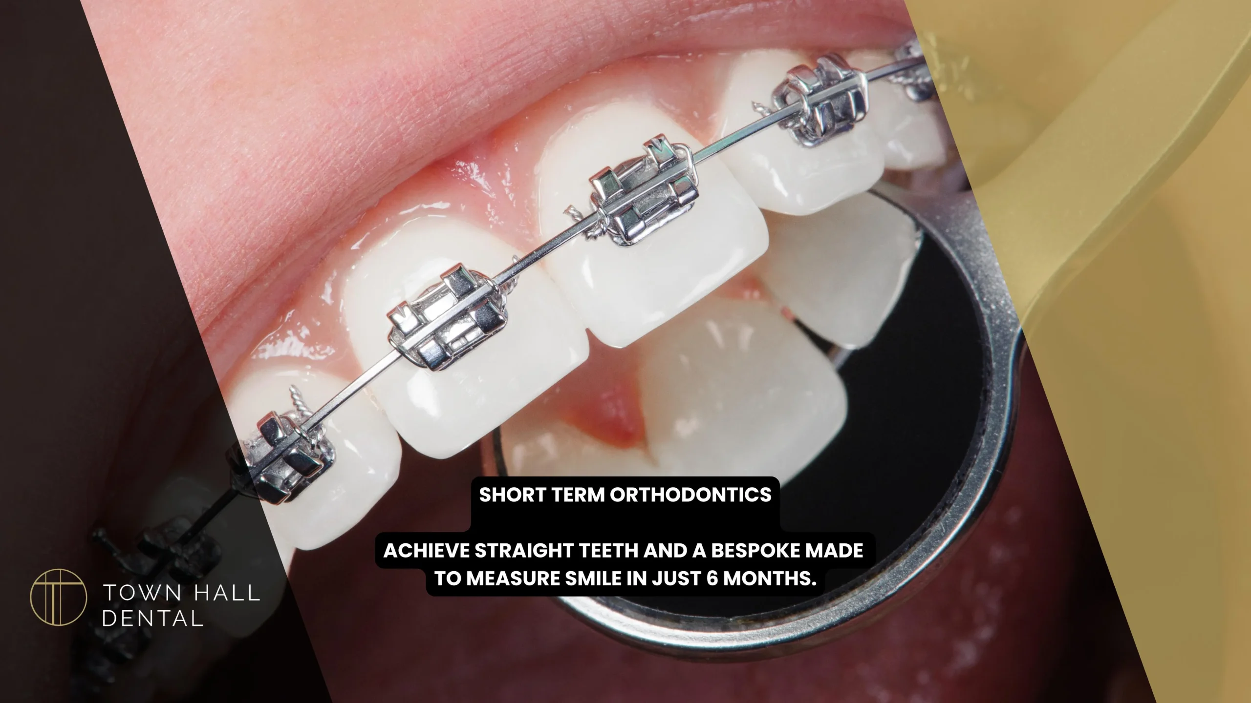 Short Term Orthodontics
