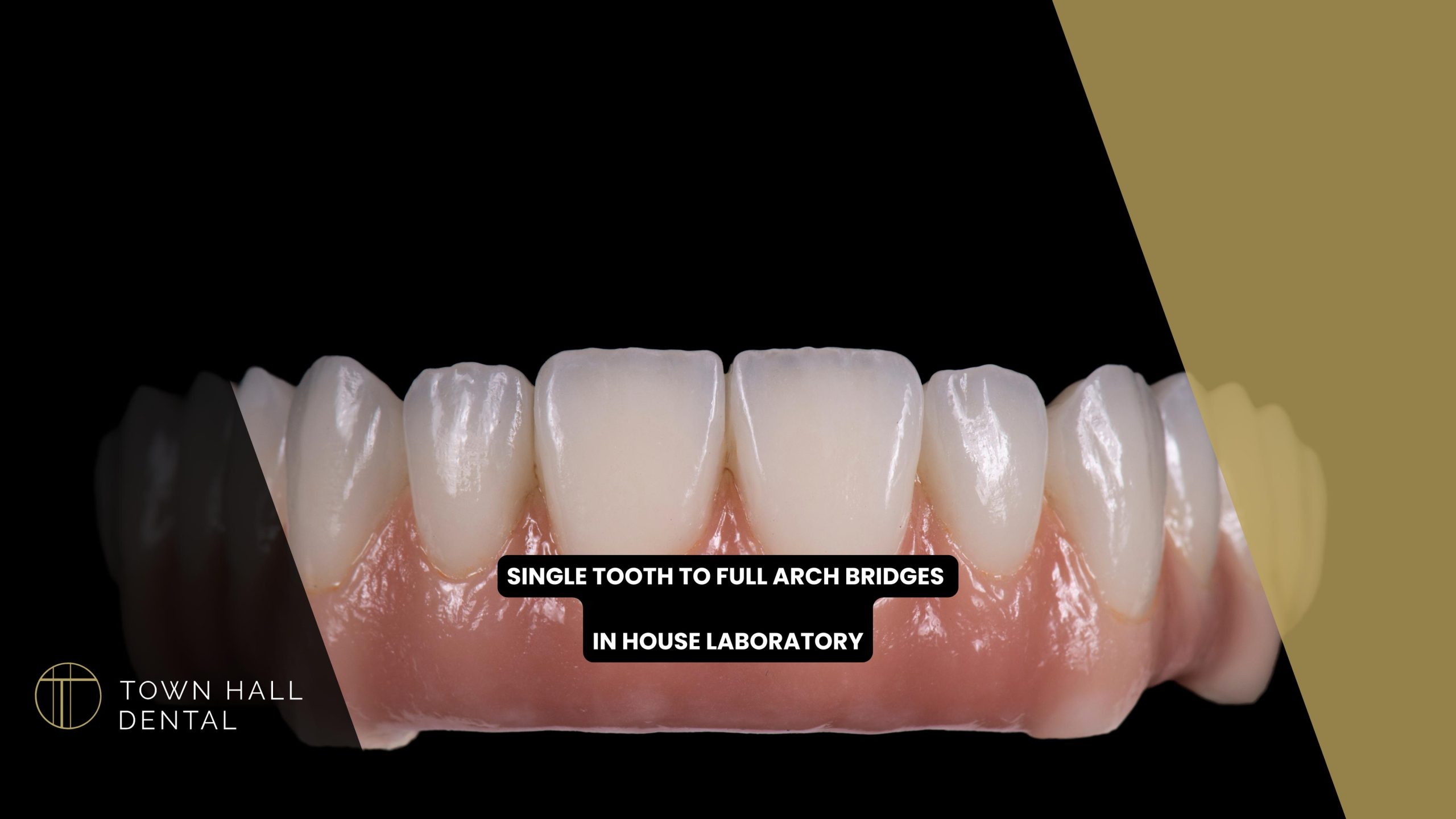 Single Tooth To Full Arch Bridges