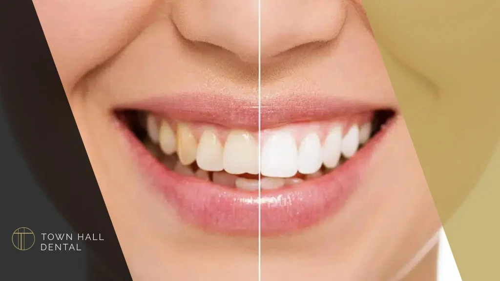 TeethWhitening-BeforeAfterImg