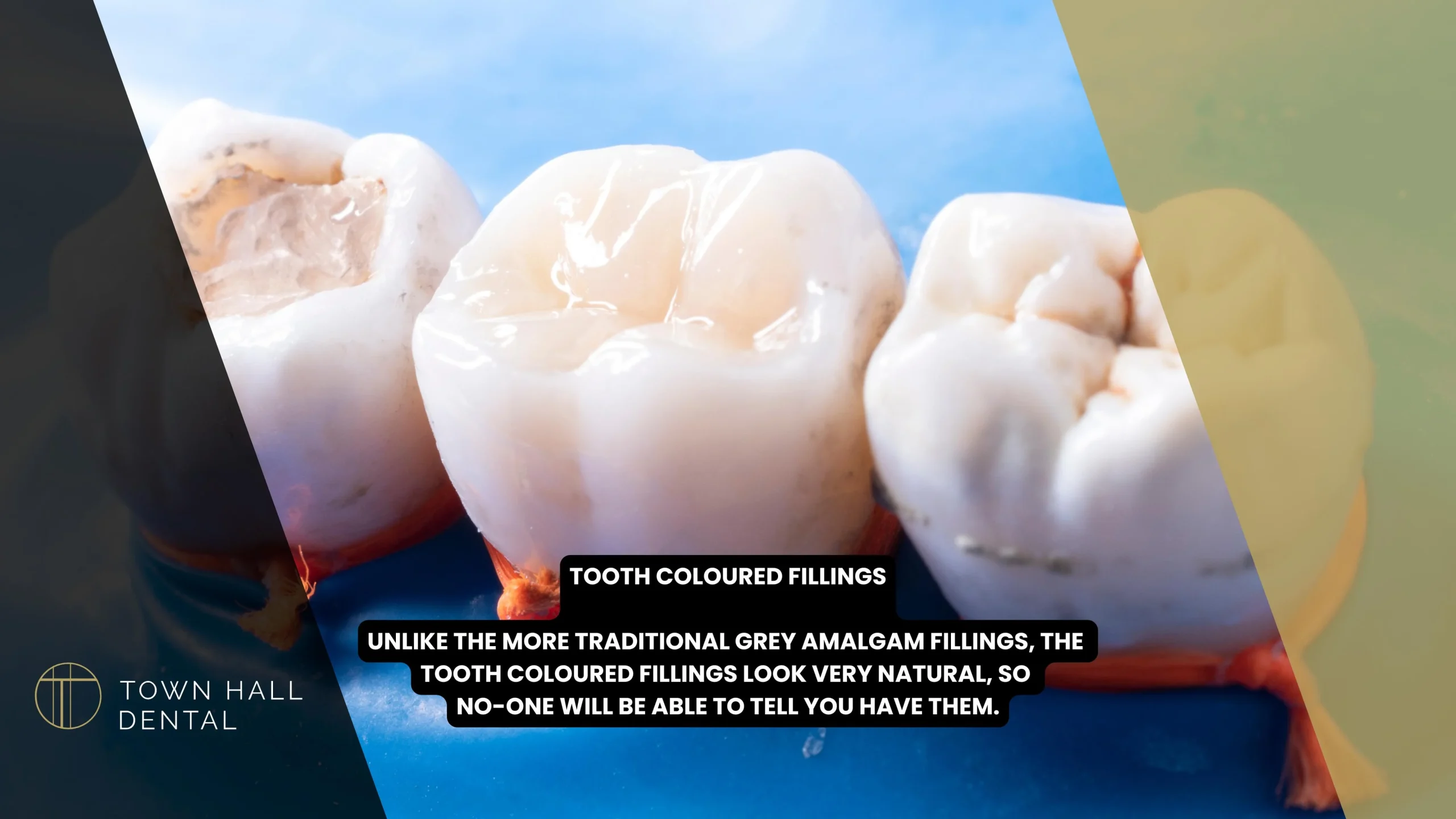 Tooth Coloured Fillings