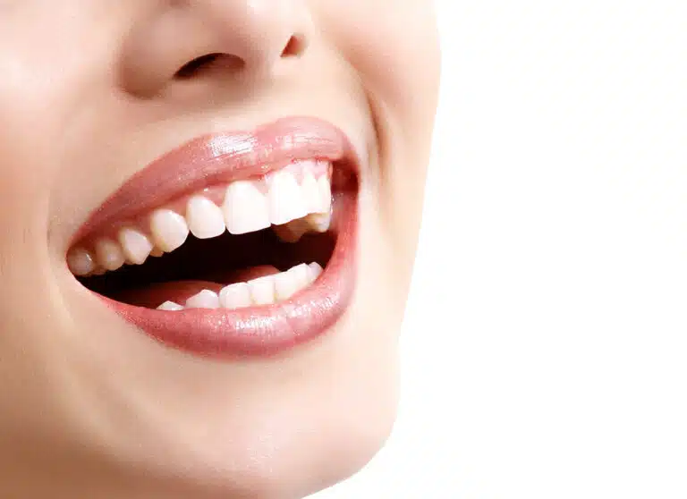 dental-veneers-768x558